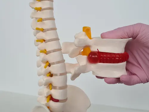 Model of Herniated Disc
